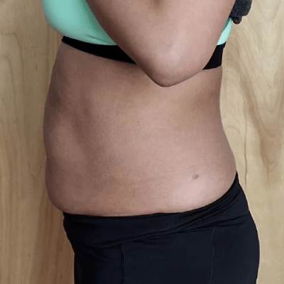 Non-Surgical Body Contouring