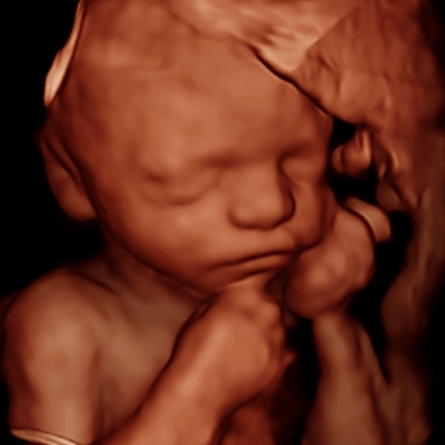 3D ULTRASOUND 