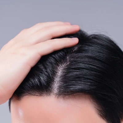 Scalp Micropigmentation