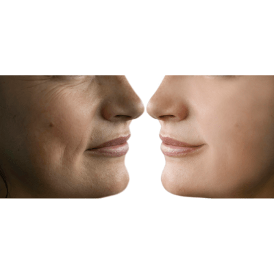 ANTI-WRINKLE TREATMENTS