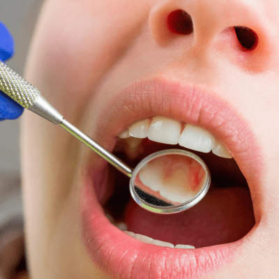 Teeth Whitening Consultation