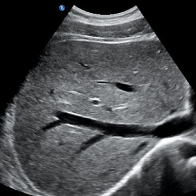 Transvaginal Ultrasound