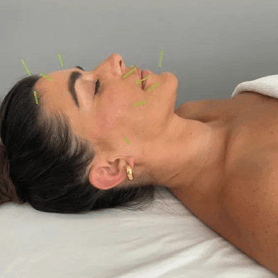Cosmetic Acupuncture