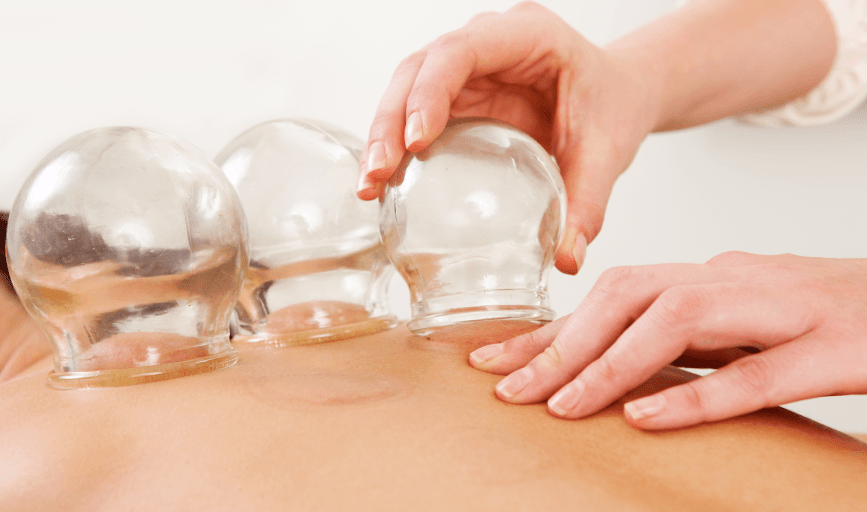 Cupping Therapy