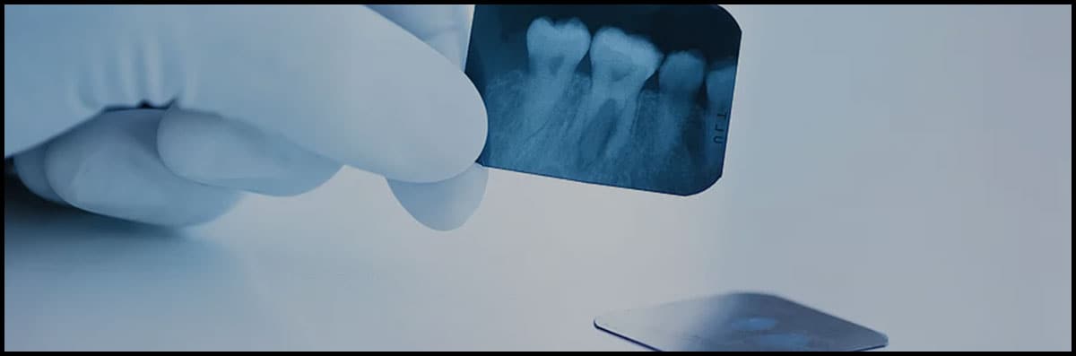 Fillings 
