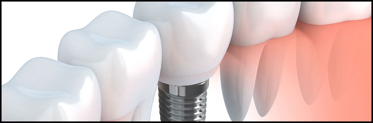 Dental Implants