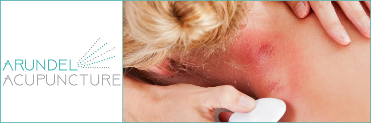 Gua Sha Treatment