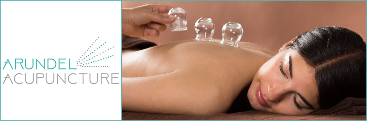 Cupping