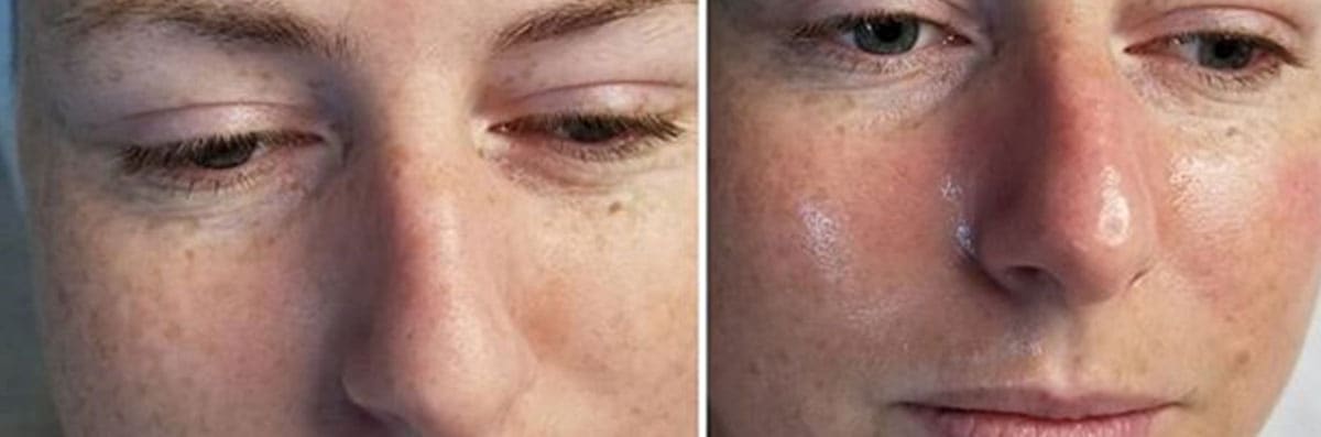 HydraFacials