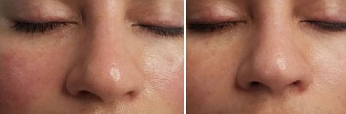 Chemical Peels