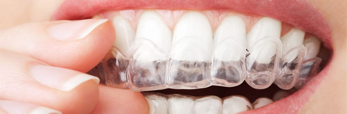 Clear Aligners