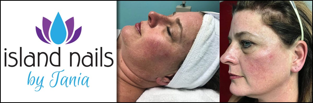 Dermaplaning