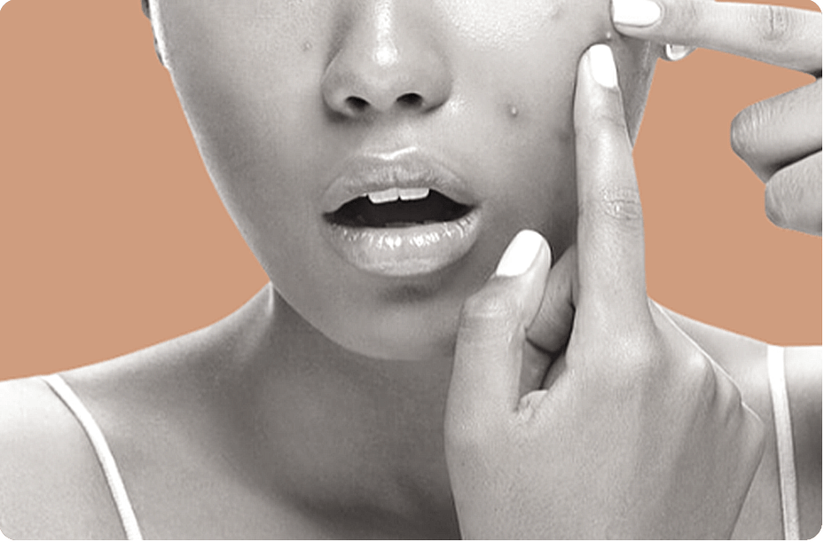 Laser Acne Treatment