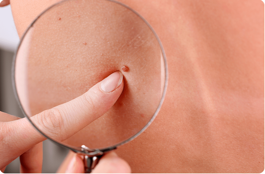 Skin Tag Removal 