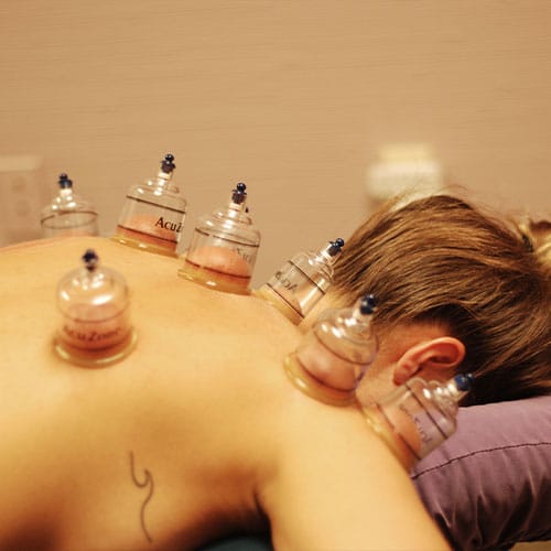 Cupping Therapy