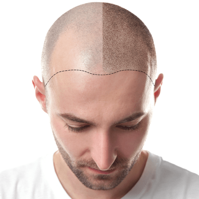 Scalp Micropigmentation