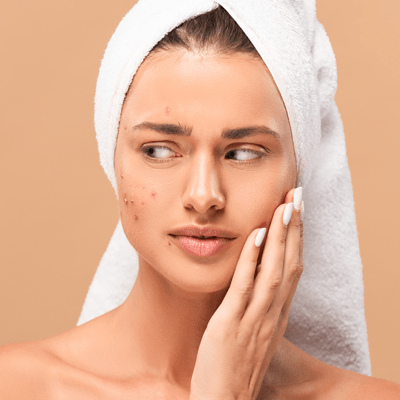Acne Skin Care