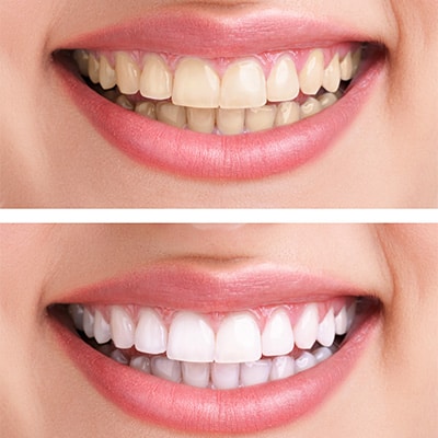 Teeth Whitening