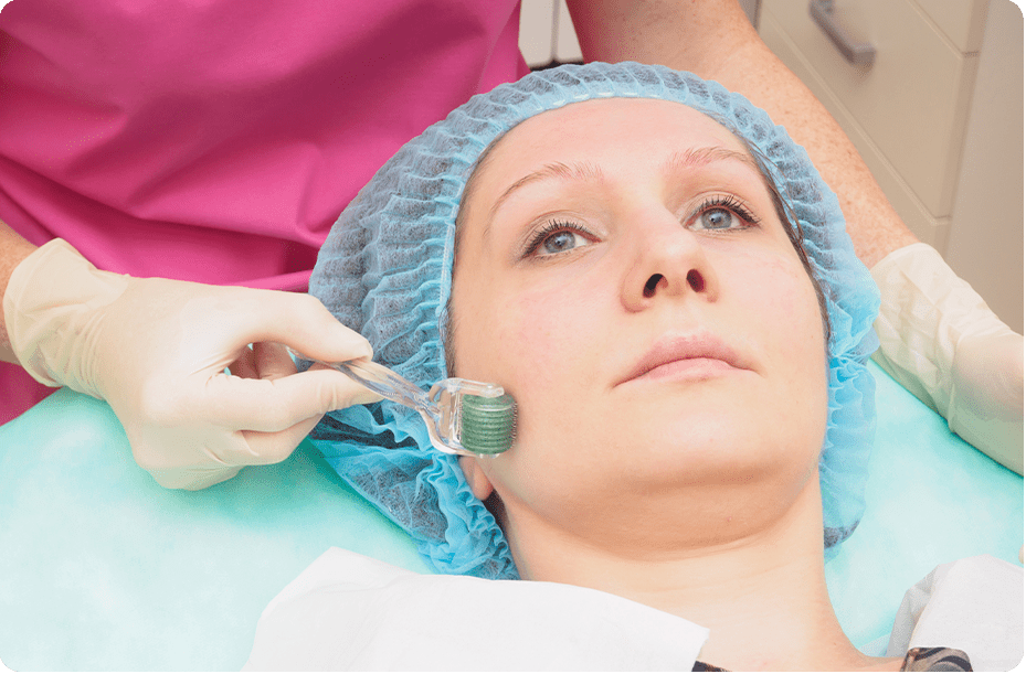 Microneedling