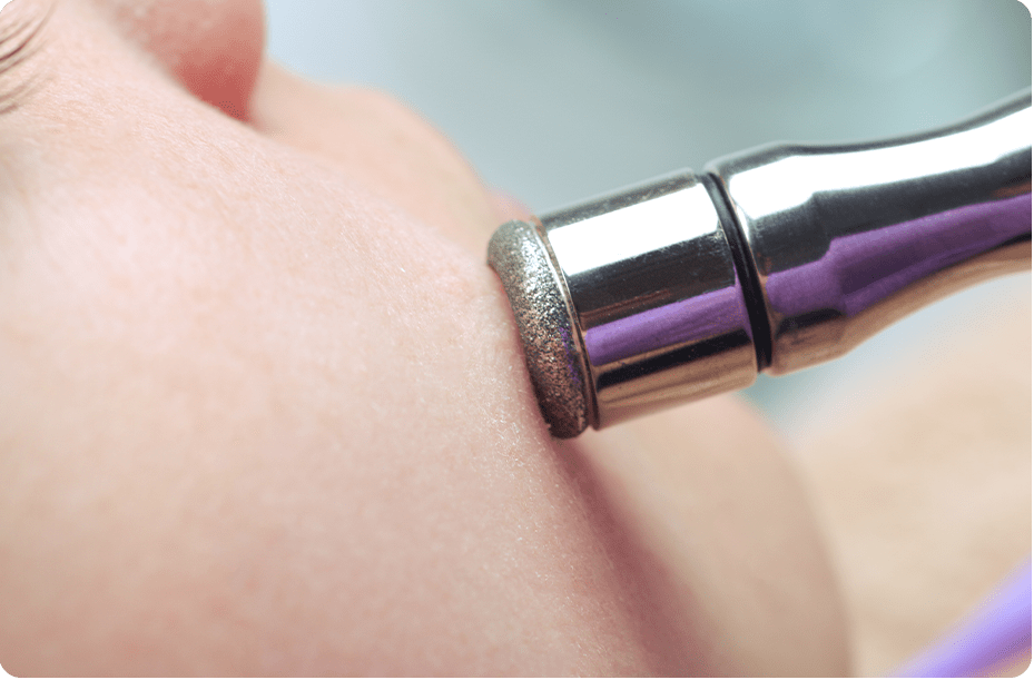 Microdermabrasion