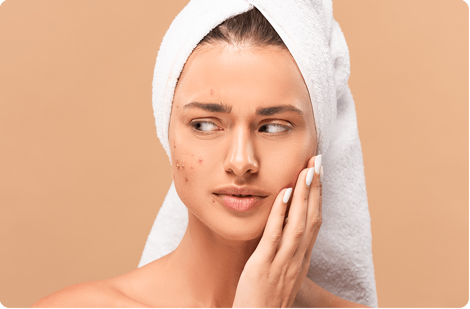 Acne Scarring Treatment