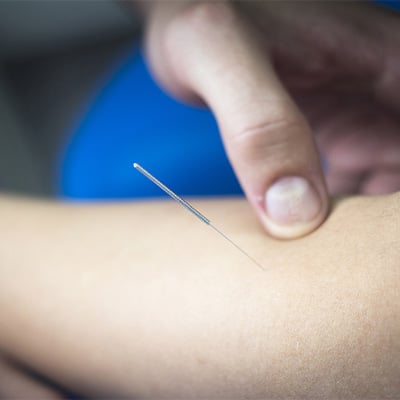 DRY NEEDLING