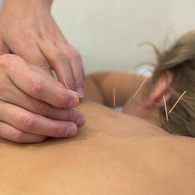 ACUPUNCTURE 