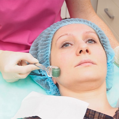 MICRONEEDLING