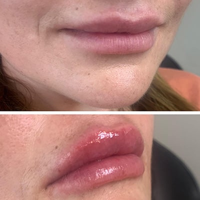 LIP FILLERS