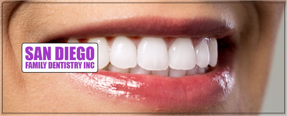 Teeth Whitening Service
