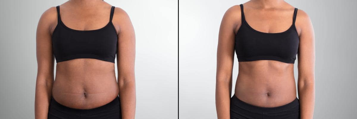 Body Contouring